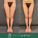 カリカリ脂肪吸引太もも3,460cc吸引 after画像 サムネイル用