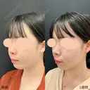 小顔脂肪吸引注射(あご下) before画像 サムネイル用