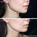 エラボトックス （小顔・歯ぎしり) before画像 サムネイル用