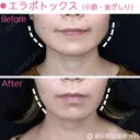 エラボトックス （小顔・歯ぎしり) after画像 サムネイル用