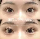 加賀デザイン＊涙袋ヒアルロン酸 before画像 サムネイル用