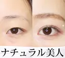 二重埋没法 after画像 サムネイル用