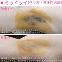 ミラドライ after画像 サムネイル用