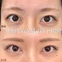 MD式眉下切開 30日後 サムネイル用