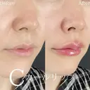 Cカールリップ before画像 サムネイル用
