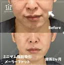 ミニマム脂肪吸引｜頬骨ダウン after画像 サムネイル用