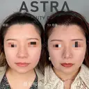 鼻尖形成 after画像 サムネイル用
