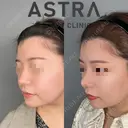 鼻尖形成 after画像 サムネイル用
