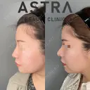鼻尖形成 after画像 サムネイル用