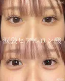 涙袋ヒアルロン酸 before画像 サムネイル用