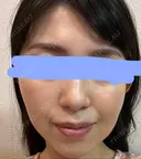 ハイフ（顔） プラチナクリニック DAY 4 サムネイル用