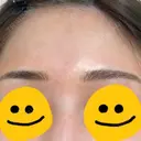 アートメイク（ほくろ） メディカルアートメイク大阪 DAY 3 サムネイル用