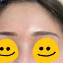 アートメイク（ほくろ） メディカルアートメイク大阪 AFTER サムネイル用