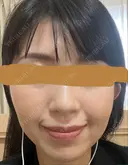 ハイフ（顔） プラチナクリニック DAY 6 サムネイル用