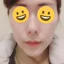 骨切り（あご） / 脂肪吸引（顔） / セットバック / ルフォー+ssro（両あご) リッツ美容外科 東京院 DAY 22 サムネイル用