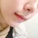 骨切り（あご） / 脂肪吸引（顔） / セットバック / ルフォー+ssro（両あご) リッツ美容外科 東京院 DAY 22 サムネイル用