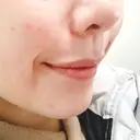 骨切り（あご） / 脂肪吸引（顔） / セットバック / ルフォー+ssro（両あご) リッツ美容外科 東京院 DAY 22 サムネイル用