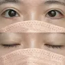 目尻切開 / タレ目形成・グラマラスライン（切開） 銀座高須クリニック DAY 35 サムネイル用