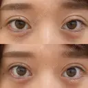二重埋没 / ヒアルロン酸注入（涙袋） Olino美容外科・美容皮膚科 DAY 6 サムネイル用