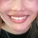 ボトックス（あご） / ボトックス（人中） Tokyo Tensei Clinic 新宿院 AFTER サムネイル用