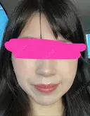 ハイフ（顔） プラチナクリニック DAY 7 サムネイル用