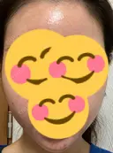 ヒアルロン酸注入（あご） / ヒアルロン酸注入（額） / ボトックス（眉間） / ピコレーザートーニング（美白・肝斑） THE FIRST CLINIC 多摩センター院 DAY 7 サムネイル用