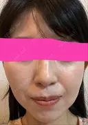 ハイフ（顔） プラチナクリニック DAY 8 サムネイル用