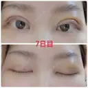 二重埋没 / 上まぶたの脂肪取り 湘南美容クリニック 奈良院 DAY 7 サムネイル用