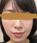 ハイフ（顔） プラチナクリニック DAY 9 サムネイル用