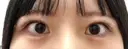 ヒアルロン酸注入（涙袋） フィラークリニック 大阪心斎橋院 DAY 0 サムネイル用