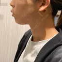 糸リフト / 脂肪吸引（顔） BLINC CLINIC （ブリンク クリニック） DAY 1 サムネイル用