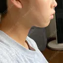 糸リフト / 脂肪吸引（顔） BLINC CLINIC （ブリンク クリニック） DAY 2 サムネイル用