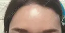ヒアルロン酸注入（涙袋） / ヒアルロン酸注入（あご） / ヒアルロン酸注入（額） / ヒアルロン酸注入（頬） / ヒアルロン酸注入（目の下） / ヒアルロン酸注入（こめかみ） お茶の水美容形成クリニック AFTER サムネイル用