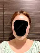 ボトックス（エラ・小顔） / ボトックス（眉間） / ボトックス（額） LE CLINIC AFTER サムネイル用