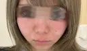 毛穴洗浄（ハイドラフェイシャルなど） / ポテンツァ A CLINIC（エークリニック） 銀座院 DAY 0 サムネイル用