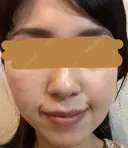 ハイフ（顔） プラチナクリニック DAY 12 サムネイル用