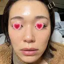 LED治療 The Natural Beauty Clinic 恵比寿院 DAY 6 サムネイル用