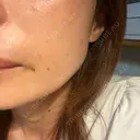 その他（肌） / ピーリング（ニキビ・毛穴） / ピーリング（ハリ・ツヤ） AURORA CLINIC（オーロラクリニック）新宿院 DAY 1 サムネイル用