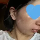 光治療（フォトフェイシャルなど） まゆりなclinic 名古屋栄 DAY 3 サムネイル用