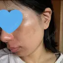 光治療（フォトフェイシャルなど） まゆりなclinic 名古屋栄 DAY 3 サムネイル用