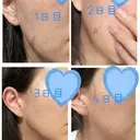 ルメッカ ルラ美容クリニック 渋谷本院 AFTER サムネイル用