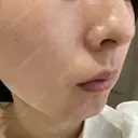 ダーマペン 美容皮膚科しらゆきクリニック DAY 0 サムネイル用