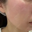 ダーマペン 美容皮膚科しらゆきクリニック DAY 0 サムネイル用