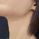 ヒアルロン酸注入（首） 湘南美容クリニック 京都院 DAY 14 サムネイル用