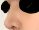 鼻尖形成（切開） / 軟骨移植 / ワシ鼻修正・ハンプ切除 / 小鼻縮小（非切開） 東京シンデレラ美容外科 池袋院 DAY 42 サムネイル用