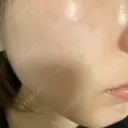 ダーマペン 美容皮膚科しらゆきクリニック DAY 1 サムネイル用