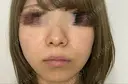 毛穴洗浄（ハイドラフェイシャルなど） / ポテンツァ A CLINIC（エークリニック） 銀座院 DAY 3 サムネイル用