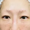 目尻切開 / タレ目形成・グラマラスライン（埋没） LOUIS CLINIC 二子玉川院【ルイクリニック】 AFTER サムネイル用