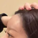 ヒアルロン酸注入（額） LA CLEF CLINIC（ラクレクリニック） DAY 1 サムネイル用