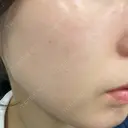 ダーマペン 美容皮膚科しらゆきクリニック AFTER サムネイル用